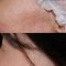Operácia nosa (Rhinoplastika)