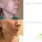 Facelift, SMAS facelifting