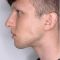 Operácia nosa (Rhinoplastika)