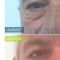 Blépharoplastie inférieure