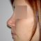 Plastika nosu (Rhinoplastika)