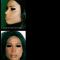 Rhinoplastie