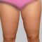 Liposuktion auf Radiofrequenz-Basis - BodyTite