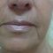 Liquid facelift