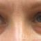 Eye Bags Treatment