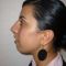 Rhinoplastie