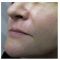 Nichtchirurgische Faltenbehandlung - BOTOX® / DYSPORT®
