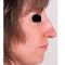 Rhinoplasty (Nose Job)