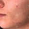 Acne laser, Cicatrici da acne laser