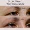 Operácia očných viečok (Blepharoplastika)