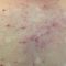 Acne laser, Cicatrici da acne laser