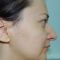 Rinoplastika (operacija nosa)