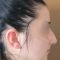 Rhinoplastie
