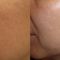 Peeling au TCA