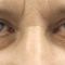 Eyelid surgery (Blepharoplasty)