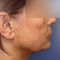 Facelift (operace obličeje), SMAS lifting