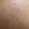 Injections de comblement
