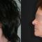 Facelift