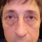 Eyelid surgery (Blepharoplasty)