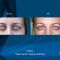 Operácia očných viečok (Blepharoplastika)