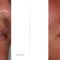 Injections d
