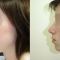 Plastika nosu (Rhinoplastika)
