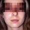 Lip augmentation (fat injection, lipofilling)