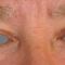 Korekcja powiek (Blepharoplastyka)