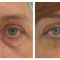Eye Bags Treatment