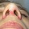 Operácia nosa (Rhinoplastika)