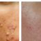 Acne laser, Cicatrici da acne laser