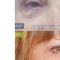 Blépharoplastie
