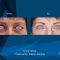 Operácia očných viečok (Blepharoplastika)