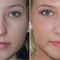 Rhinoplasty (Nose Job)
