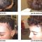 Haarausfall Therapie