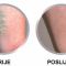 Varicose veins laser treatment
