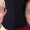 Ear surgery (Otoplasty)