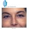 Blépharoplastie