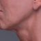 Radiesse (Calcium hydroxylapatit)
