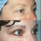 Blépharoplastie