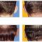 Ear surgery (Otoplasty)