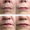 Rádiofrekvenčná rejuvenácia(Aluma, accent, TriPollar, Spa RF, Re-Age)