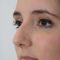 Rhinoplastie Ultrasonique