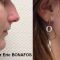 Rhinoplastie