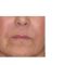 Filler antirughe a base di acido ialuronico