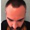Trapianto capelli