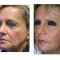 Lipofilling (grasso)