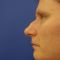 Plastika nosu (Rhinoplastika)