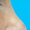 Plastika nosu (Rhinoplastika)