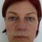 Ear surgery (Otoplasty)